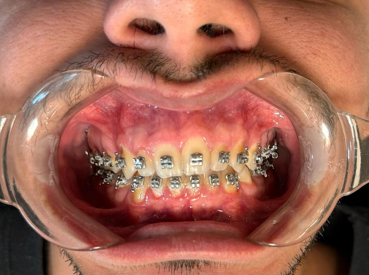 Aparelho ortodôntico fixo metálico montado nos arcos dentários