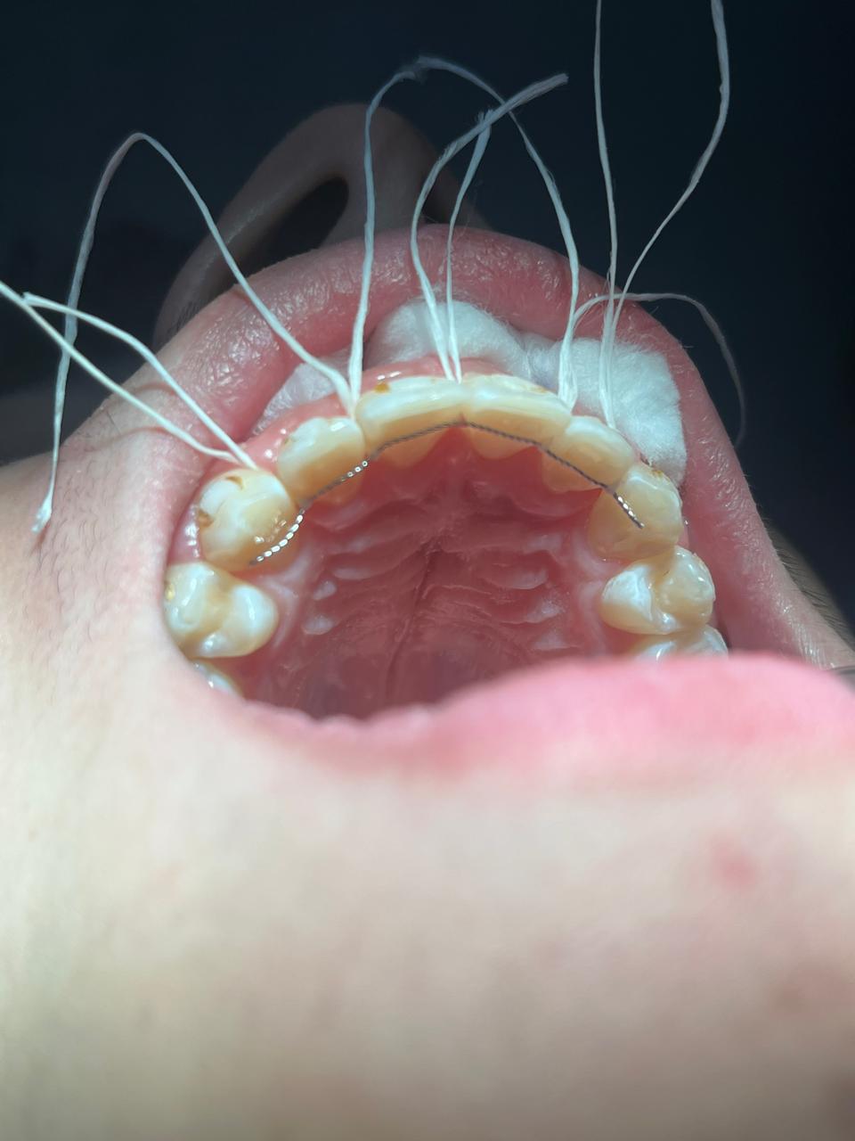 Contenção fixa colada na face palatina dos dentes superiores
